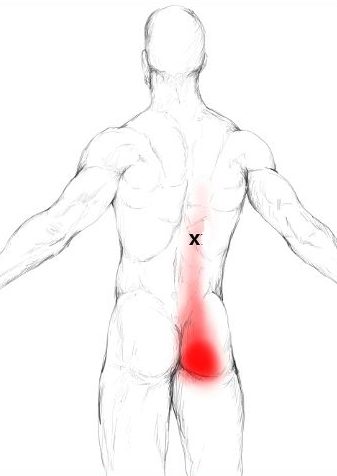 Douleur de la fesse et Point Trigger du muscle Long Thoracique